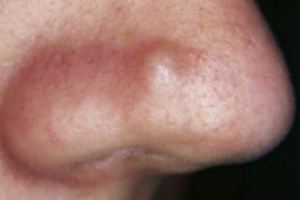 Cyst on Nose Picture