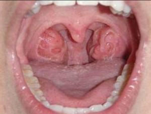 Holes in Tonsils: Causes, Pictures, Meaning, No Pain, Get Rid, Treatment