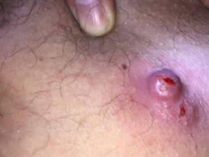 Infected Ingrown Hair Cyst
