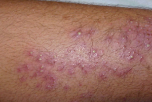 Itchy Lower legs could be a symptom of Folliculitis