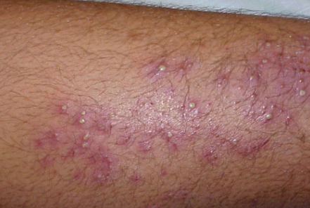 Folliculitis On Lower Legs