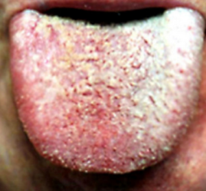 Itchy Tongue Food Allergy