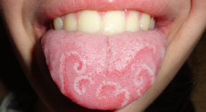 Itchy Tongue meaning- what you should you know