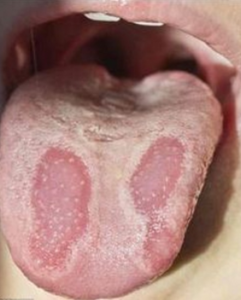 Itchy Tongue with White Coating - Picture