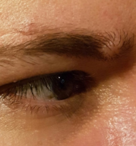 Lump on Eyebrow Picture