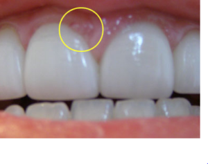 Lump on Gum Picture 2