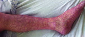 Mottled Skin in Legs
