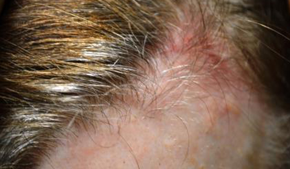 Shingles on Scalp: Symptoms, Pictures, Contagious, No Rash, With