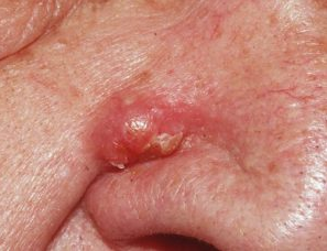 Sebaceous Cyst on Nose