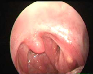 Tonsil Cyst