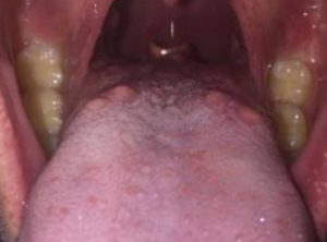 What Causes Bumps to appear on back of Tongue