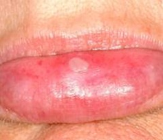What Causes White Bumps on Lips - Pictures