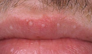 White Bumps On Lips Causes Pictures Lower Upper Inside Lip   White Bumps On Lips Picture 300x176 