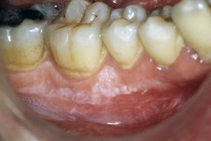 White Spots or Patch could be Leukoplakia